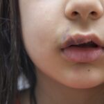 Comissão debate políticas públicas de atenção integral às pessoas com fissura labiopalatina – Notícias