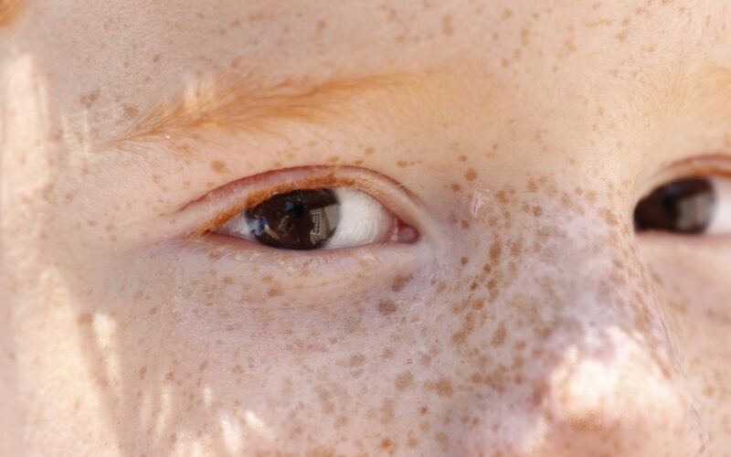 Reflexo branco nos olhos: entenda condição que assusta pais